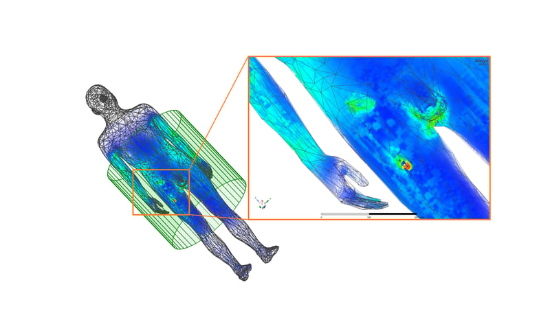 Transient thermal simulation showing the RF-induced heat hotspot at the end of an orthopedic hip implant in a homogeneous body model. | © Joshua Igl, OTH Amberg-Weiden