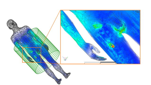Transiente Temperatursimulation zeigt den HF-induzierten Wärme-Hotspot am Ende des orthopädischen Hüftimplantats in einem homogenen Körpermodell. | © Joshua Igl, OTH Amberg Weiden